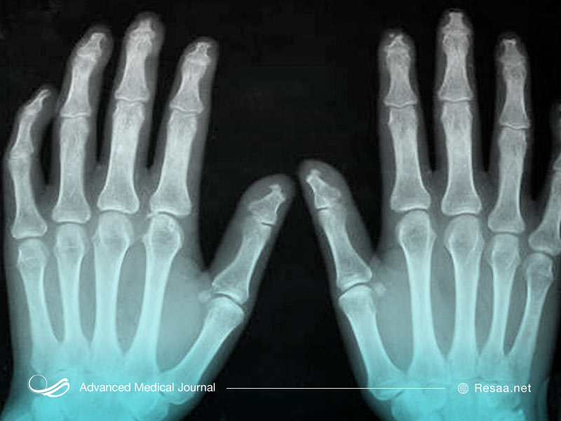 مشکلات ئوستی یکی از عوارض بیماری اسکلرودرمی میباشد.