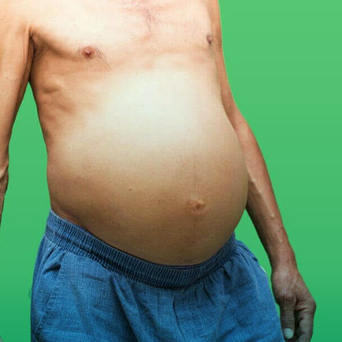 آسیت یا آب آوردن شکم چیست