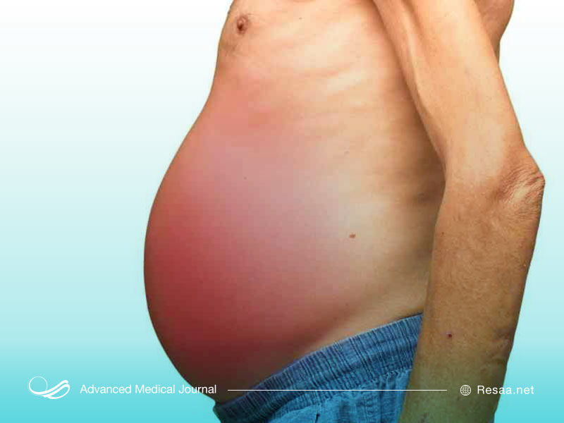 پیشرفت سیروز کبدی می‌تواند منجر به آسیت شود.