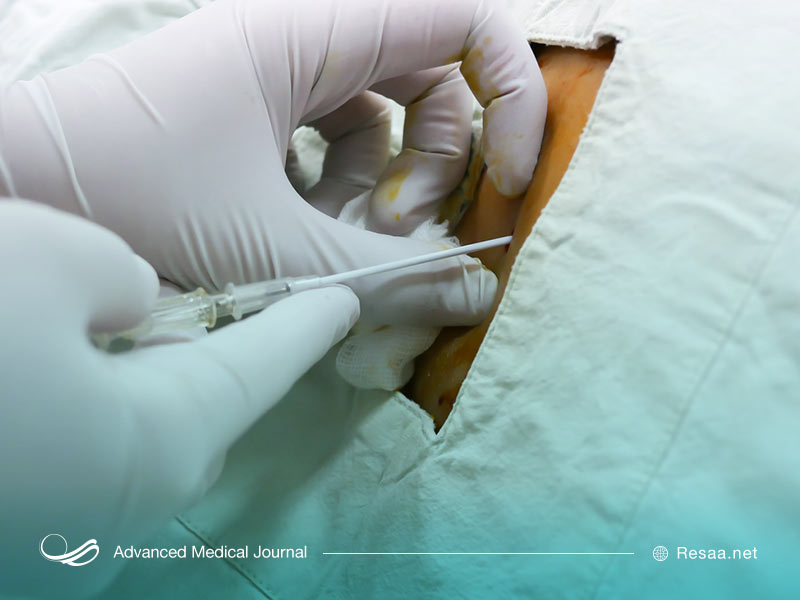 درمان آسیت با عمل جراحی