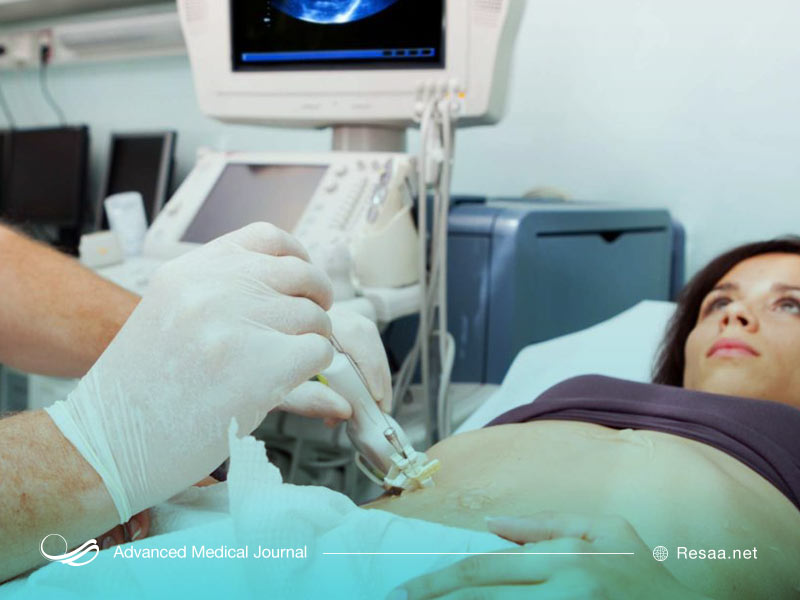 پیوند کبدی یکی از راه‌های درمان آسیت می‌باشد.