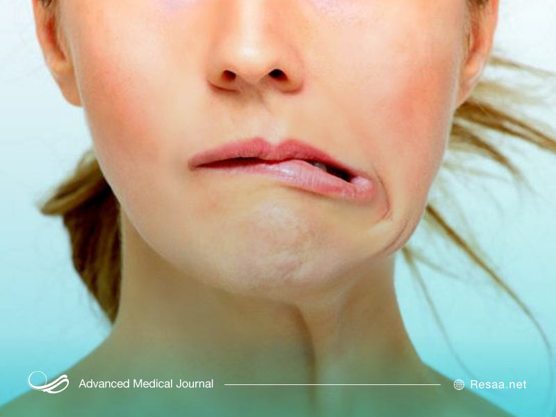 فلج بل یا کج شدن لبخند شما همراه است.