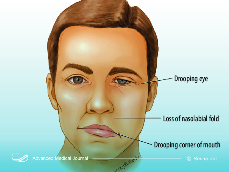 فلج بل بر اعصاب صورت شما تاثیر می‌گذارد.