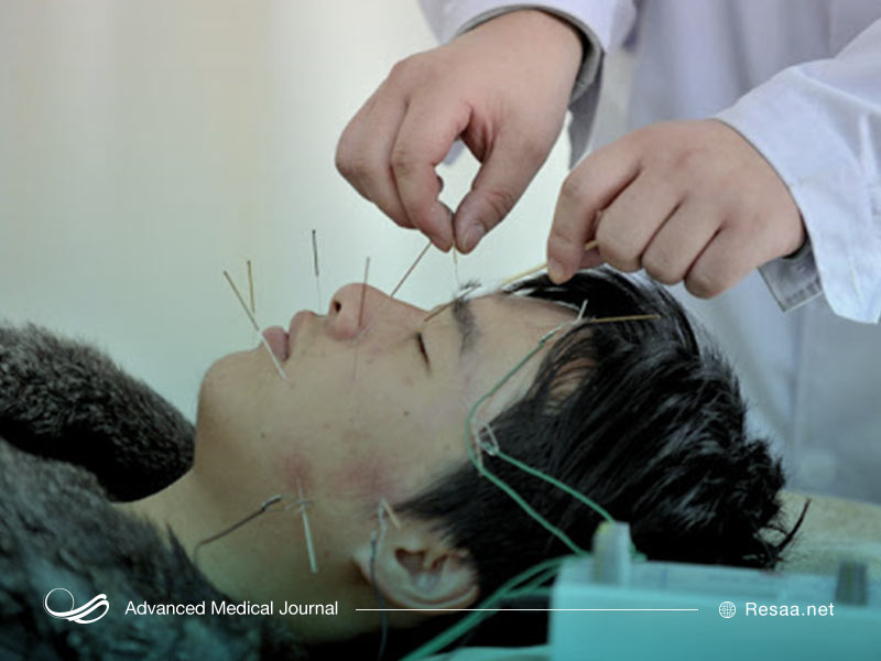 طب سوزنی میتواند به بهبود علائم فلج بل کمک کند.