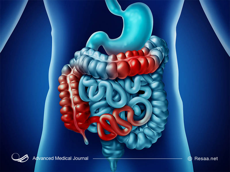 کرون نوعی بیماری التهابی روده است.