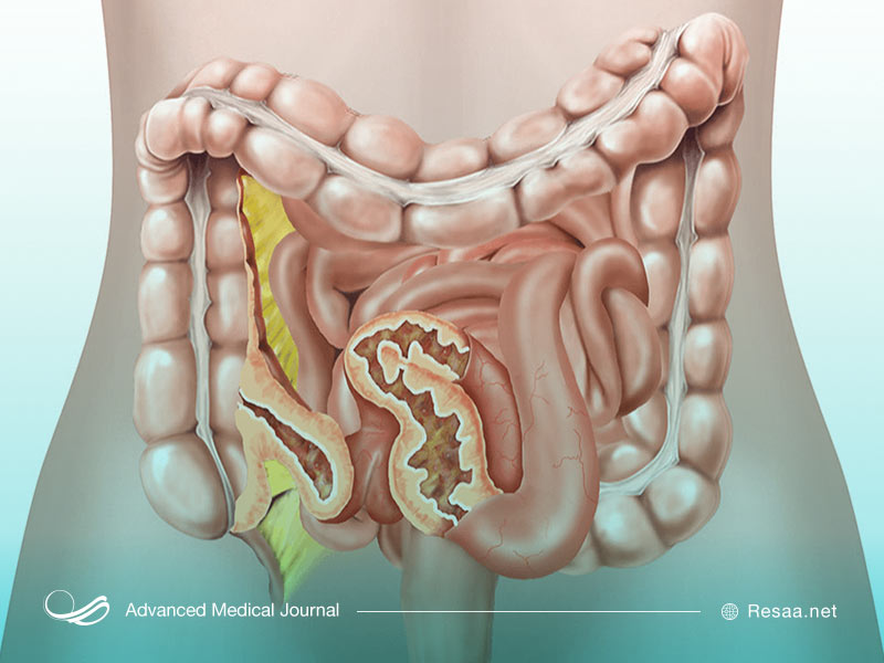 اگر به بیماری کرون مبتلا باشید ممکن است علائم مختلفی را تجربه کنید.