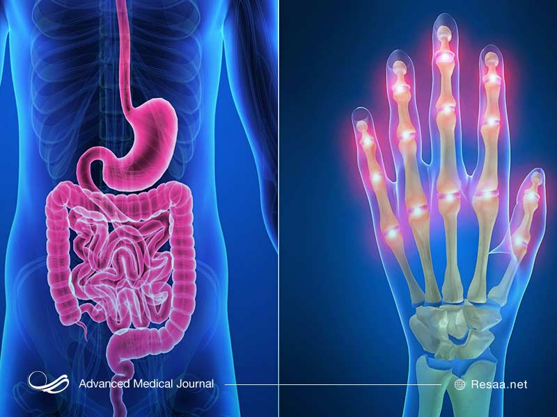 عمل جراحی می‌تواند یکی از گزینه‌های درمانی برای بیماری کرون باشد.