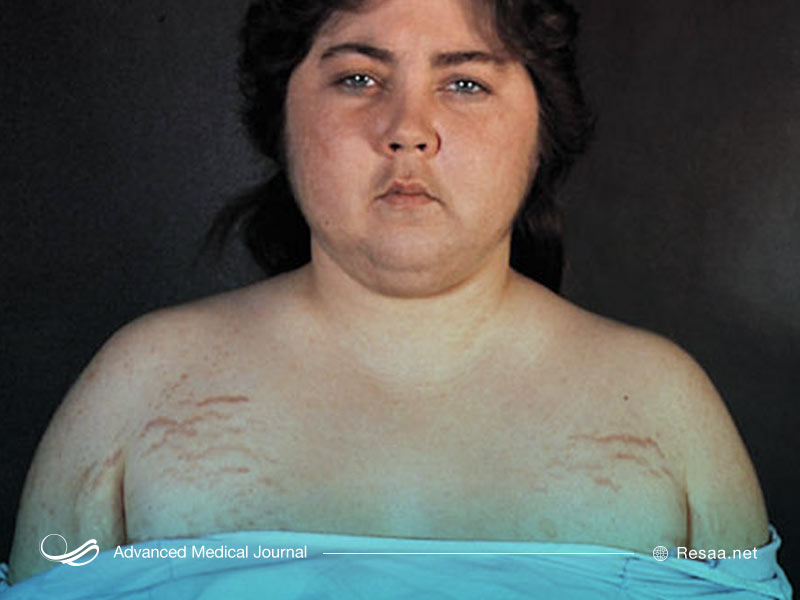 سندروم کوشینگ در اثر اختلالات هورمونی ایجاد میشود.