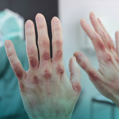 بیماری پوستی درماتیت