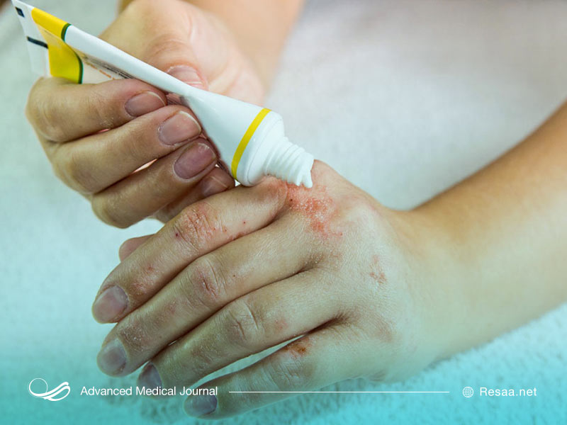 برای درمان درماتیت ممکن است داروهای مختلفی برای شما تجویز گردد.