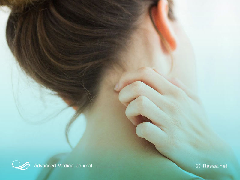 حساسیت و آلرژی نسبت به برخی مواد غذایی می تواند سبب درماتیت شود.