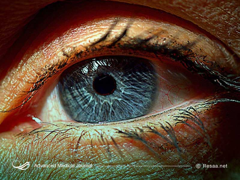 پارگی شبکیه چشم یک مشکل جدی چشم است.