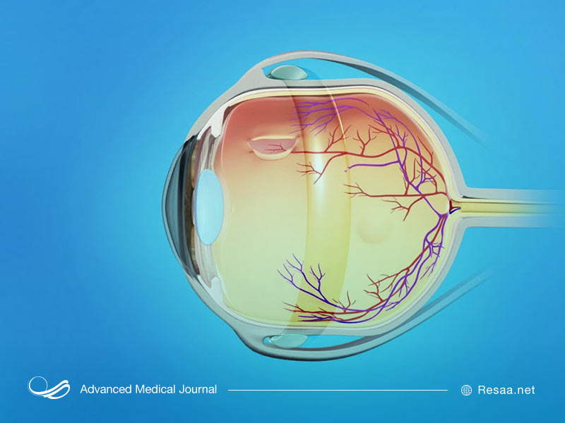 داشتن آب مروارید می‌تواند زمینه ای برای پارگی شکیه چشم باشد.