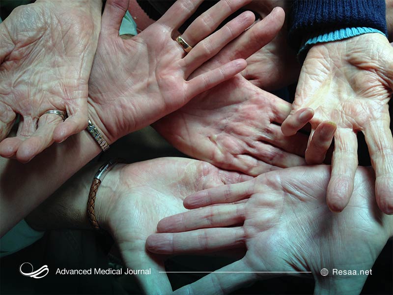 بیماری دوپویترن سبب ضخیم شدن پوست کف دست می شود.