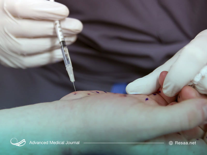 هنوز درمان قطعی برای دوپویترن پیدا نشده است اما گزینه‌های درمانی برای این بیماری وجود دارد.