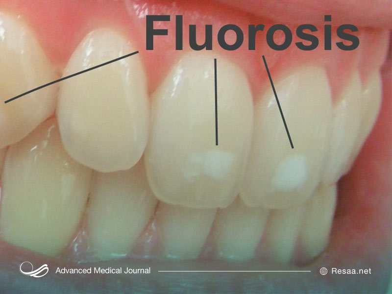 فلوئوروزیس در اثر مصرف زیاد فلوراید اتفاق می‌افتد.