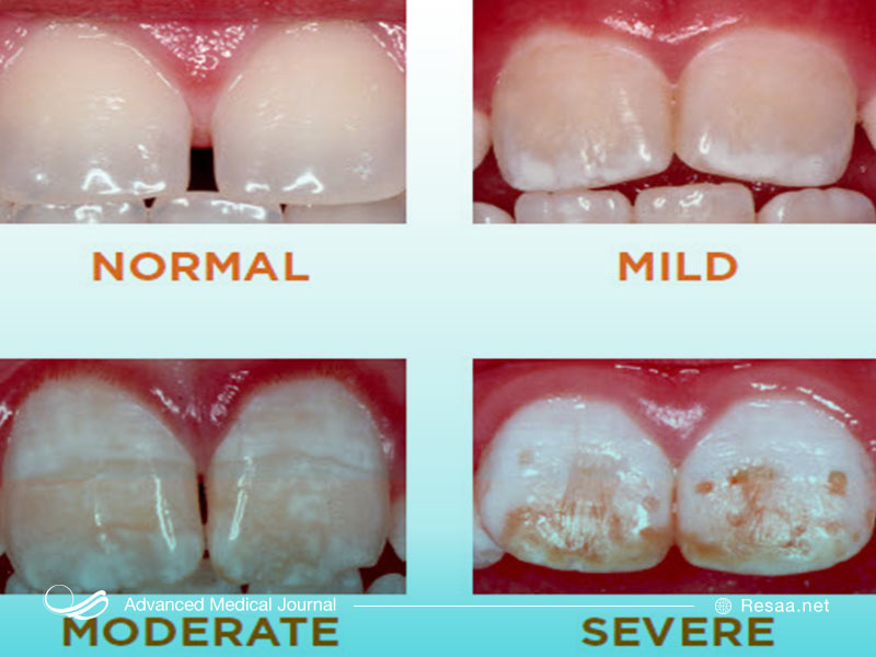 درجات مختلف آسیب دیدگی توسط فلوراید که منجر به فلوئوروزیس می شود.