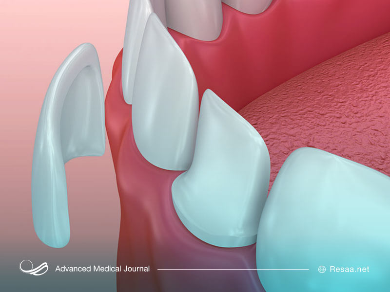 روکش‌های دندانی یکی از راهکارهای جلوگیری از فلوئوروزیس است.