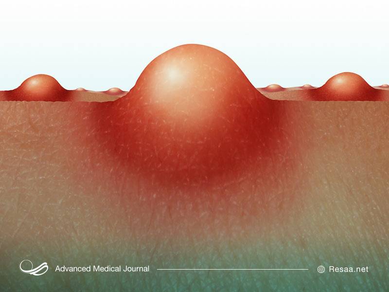 کورک در اثر عفونت در پیاز مو ایجاد میشود.