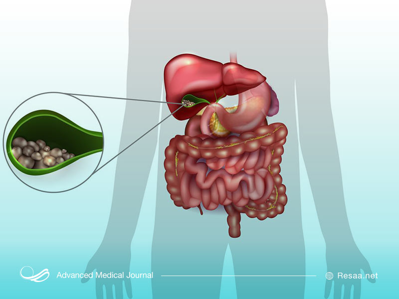 تشخیص بیماری گوچر