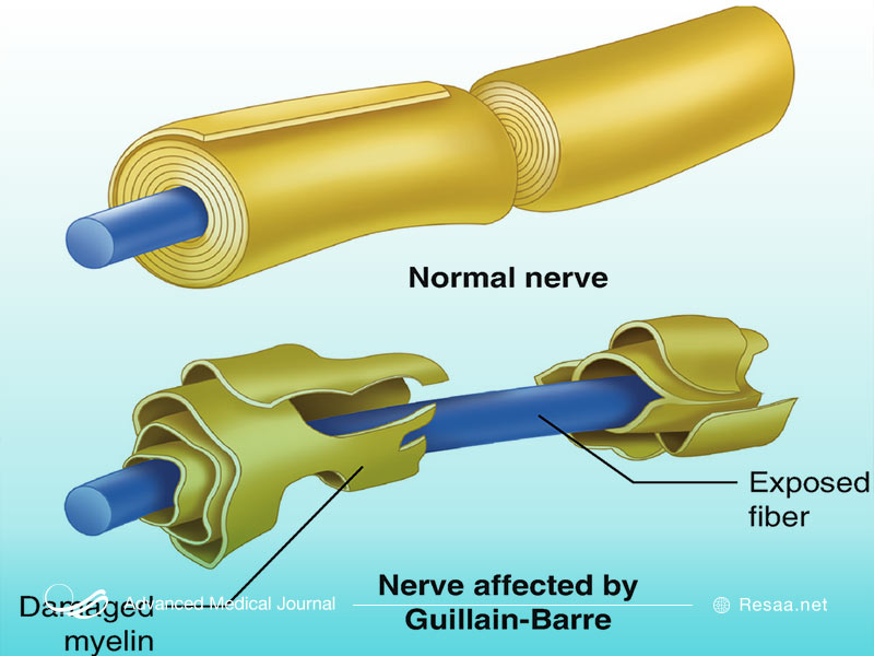 بیماری گیلن باره روی اعصاب محیطی تاثیر می گذارد.