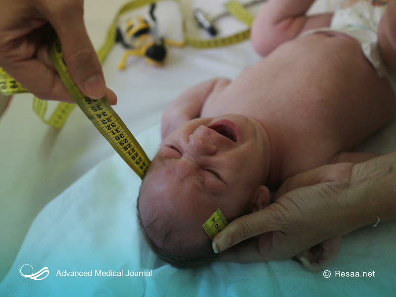 زرگ شدن سر یکی از علائم هیدروسفالی است.