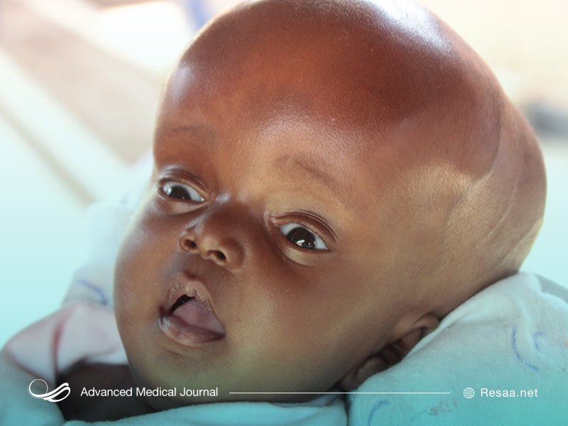 هیدروسفالی سب آسیب مغزی می‌شود.