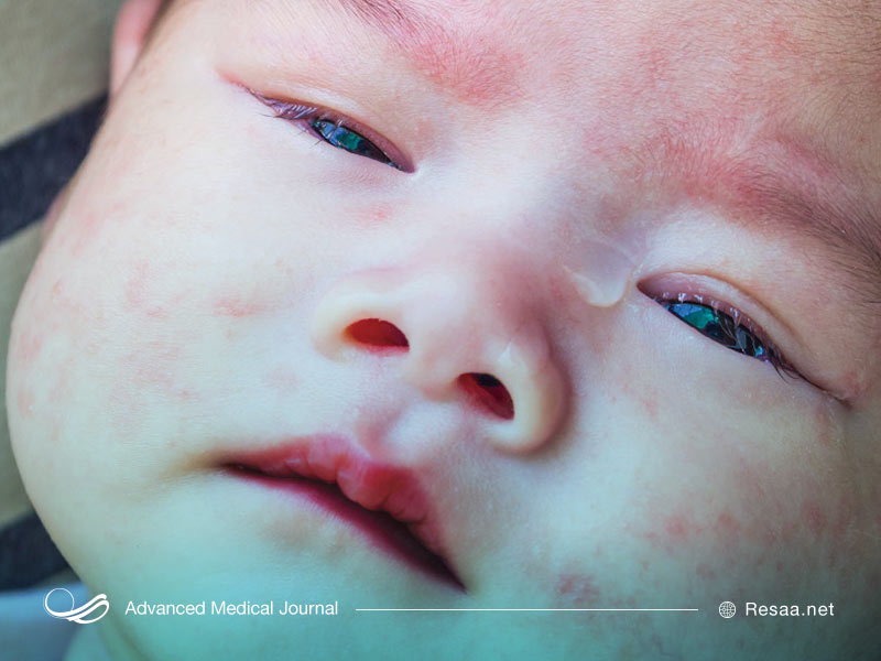 عوامل ژنتیکی در بروز بیماری کاوازاکی موثر هستند.