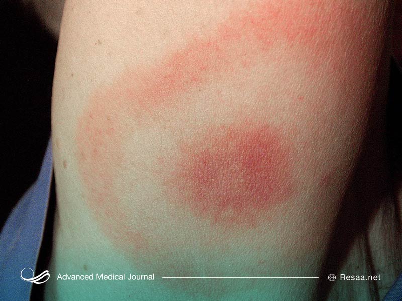 علایم بیماری لایم ممکن است هفته‌ها پس از ابتلا بوجود بیایند.