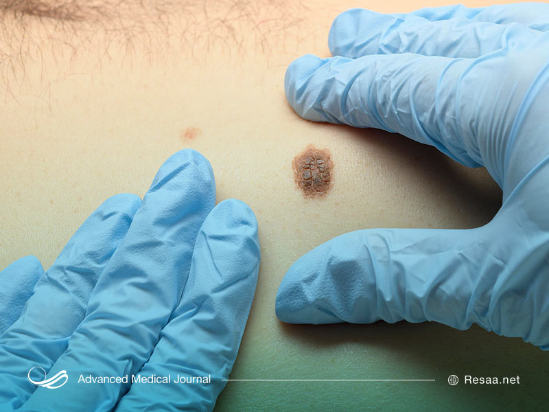 ملانوما جدی‌ترین نوع سرطان پوست می‌باشد.