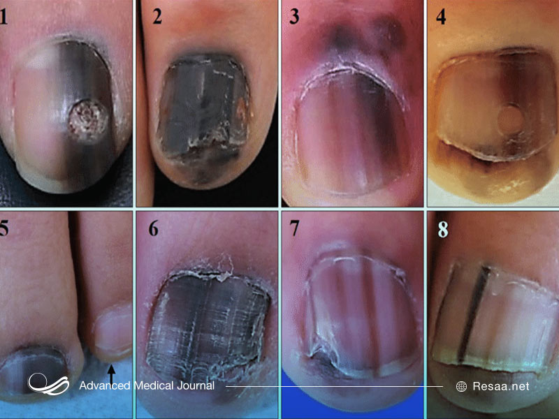 ملانوما روی ناخن‌ها نیز اثر می‌کذارد و سبب تغییر رنگ آن‌ها می‌شود.