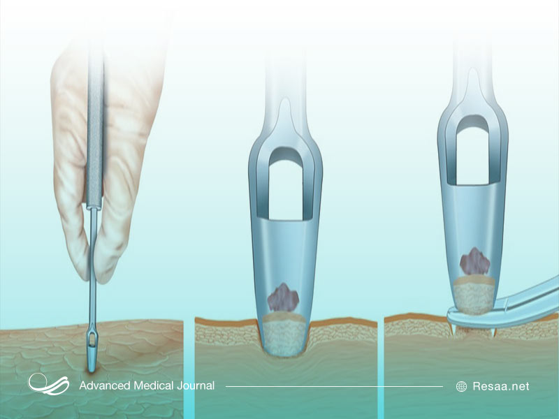 برای تشخیص ملانوما از بافت بدن نمونه‌برداری می‌شود.