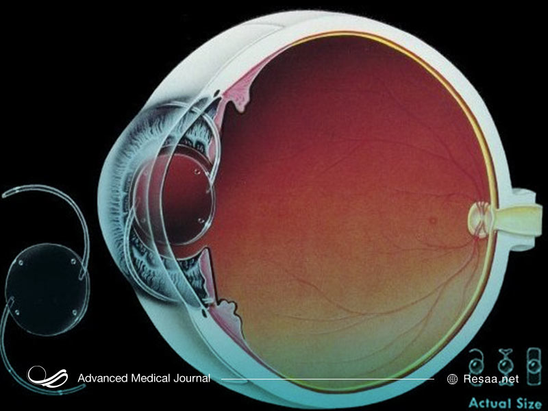 Искусственный хрусталик глаза фото как выглядит