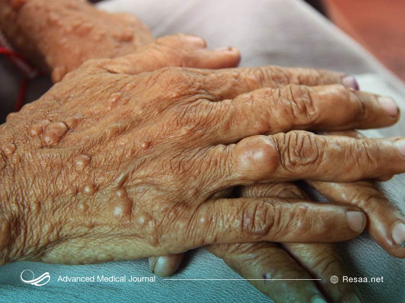 نوروفیبروماتوز نوعی بیماری پوستی است.