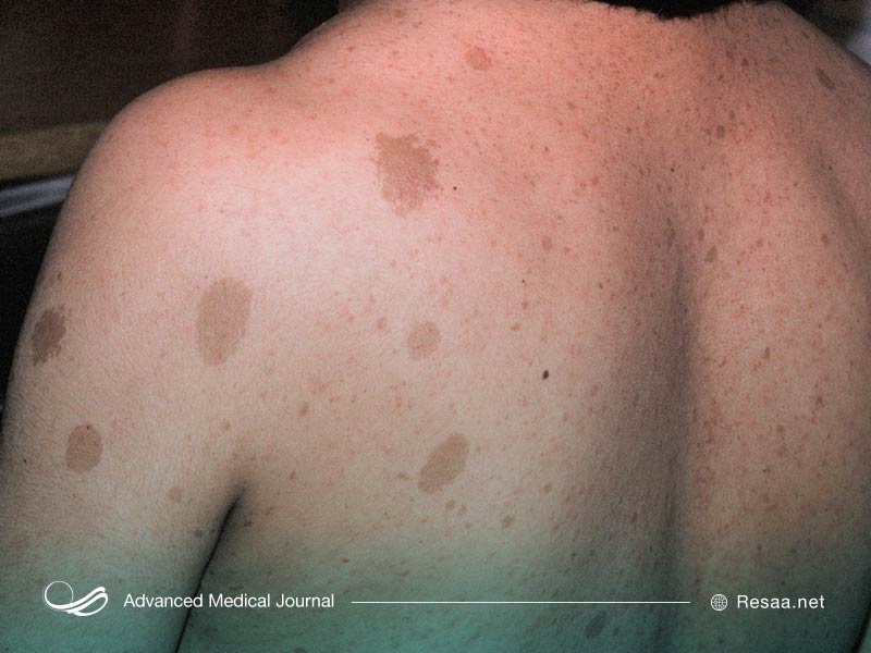 نوروفیبروماتوز نوعی بیماری ژنتیکی عصبی است.