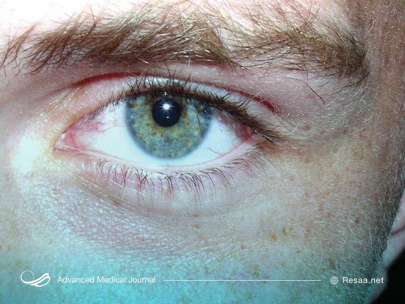 این بیماری می‌تواند روی اندام مختلفی تاثیر بگذارد