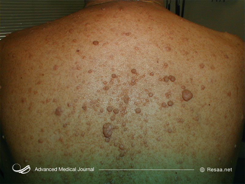 نوروفیبروماتوز به شکل ضایعات پوستی بروز پیدا می‌کند.