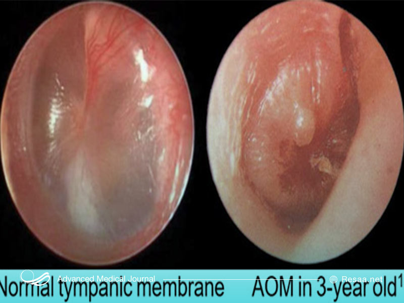 عفونت گوش انواع و درجات مختلفی دارد.