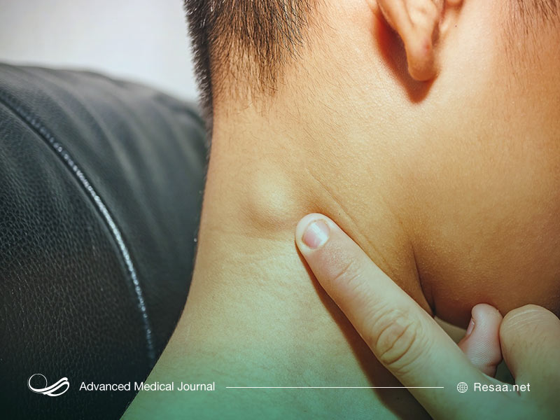 سارکوئیدوز نوعی بیماری التهابی مربوط به ریه‌هاست