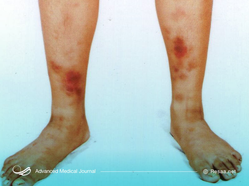 سارکوئیدوز می‌تواند سبب بروز زخم‌های پوستی شود.