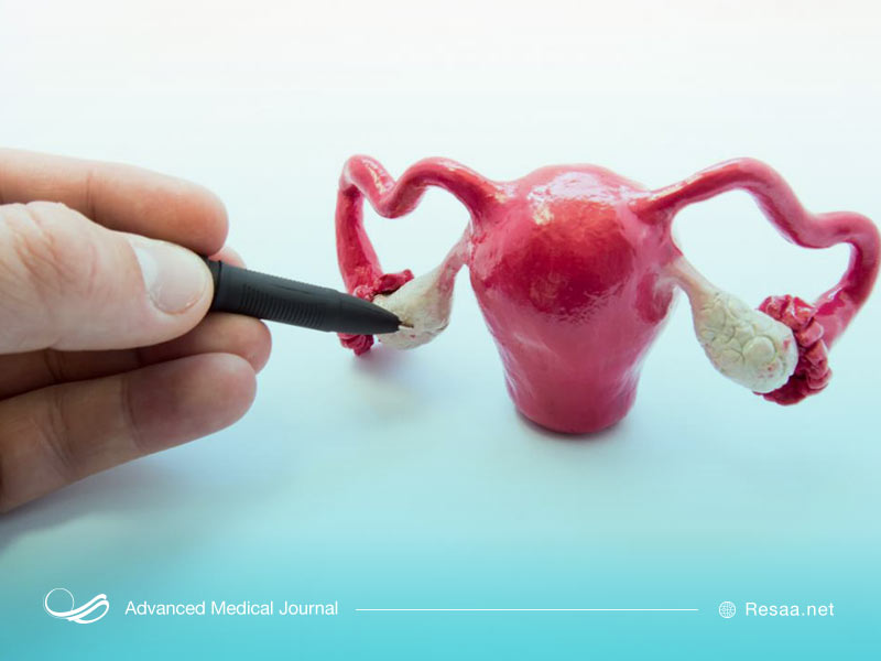 پیچ خوردگی تخمدان سبب درد در ناحیه شکم میشود.