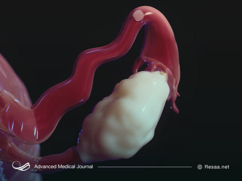 سونوگرافی میتواند پیچ خوردگی تخمدان را نشان دهد.