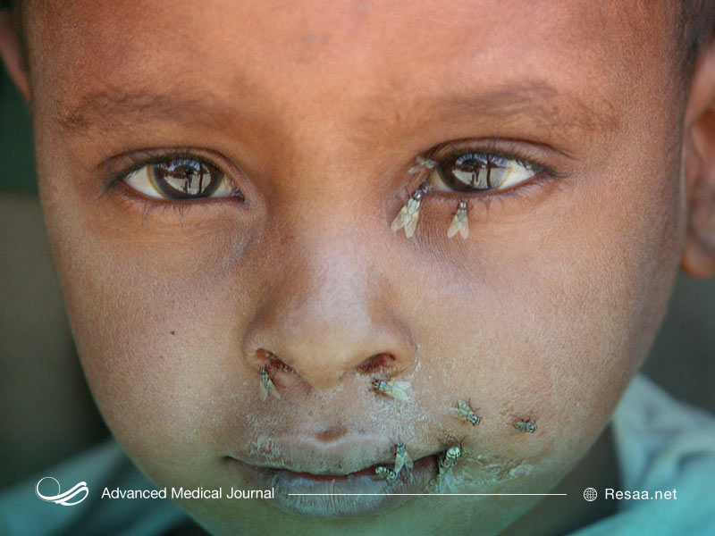 عفونتهای مکرر باعث ایجاد التهاب در چشم و در موارد حادتر سبب نابینایی میشود.