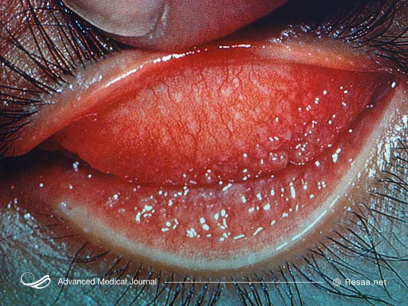 تراکوما میتواند باعث جراحت قرنیه شود.