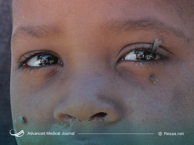 تراکوما آسیب جدی به چشمها وارد میکند.