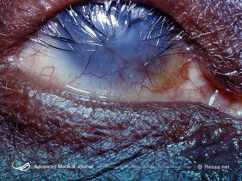 تراخم سبب کاهش بینایی میشود.