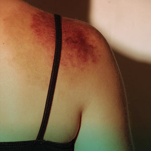 بیماری ون ویلبراند چگونه به بدن آسیب میرساند