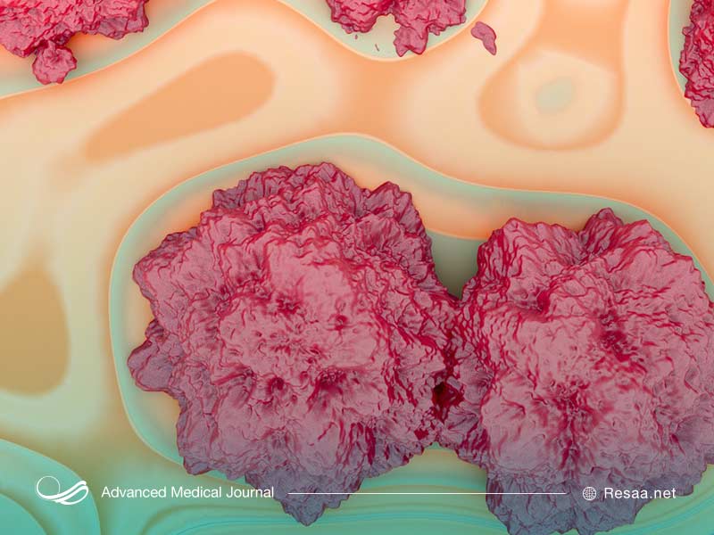 هایپرکلسمی بدخیم از عوارض انواع سرطان‌هاست.