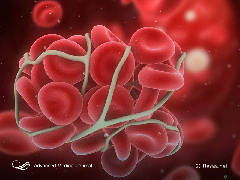 سندروم آنتی فسفولیپید نوعی بیماری ایمنی بدن است