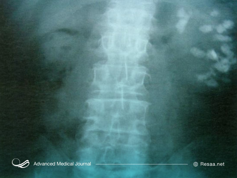 نفروکلسینوز و رسوب کلسیم